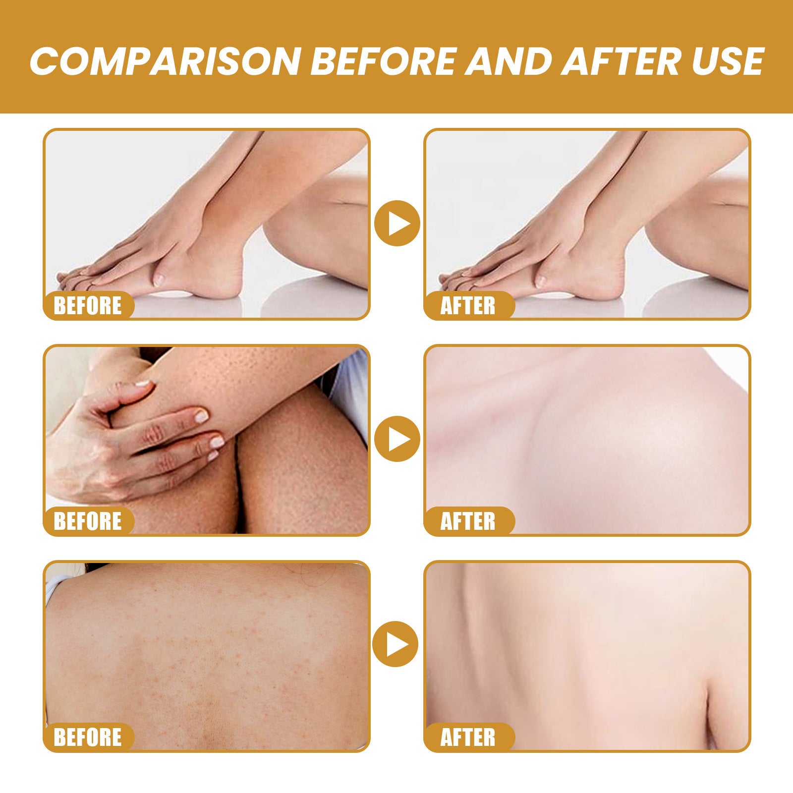 Crème Gommage Corps au Curcuma Atténuation des Cicatrices de Variole Hydratante Rafraîchissante Lissante Rajeunissante Nettoyante Exfoliante Corporelle