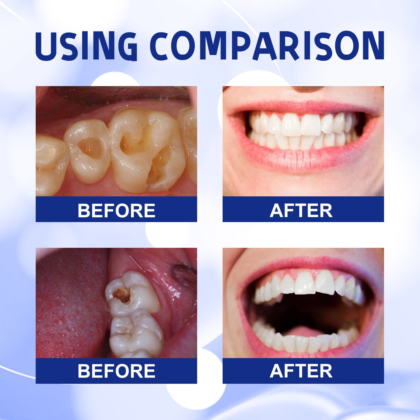 Dentifrice Anticaries Nettoyage Buccal Jaunissement Dentaire Carie Soin Dentaire Fixation Gencives Soin Dentaire Haleine
