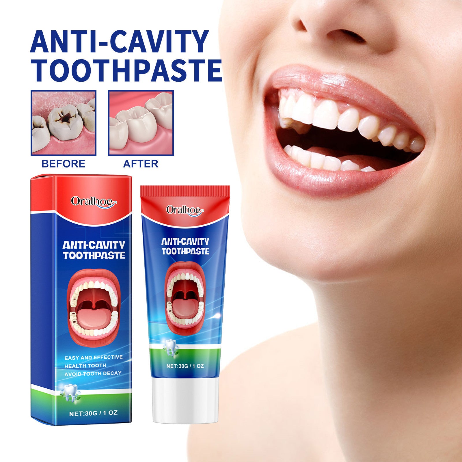 Dentifrice Anticaries Nettoyage Buccal Jaunissement Dentaire Carie Soin Dentaire Fixation Gencives Soin Dentaire Haleine