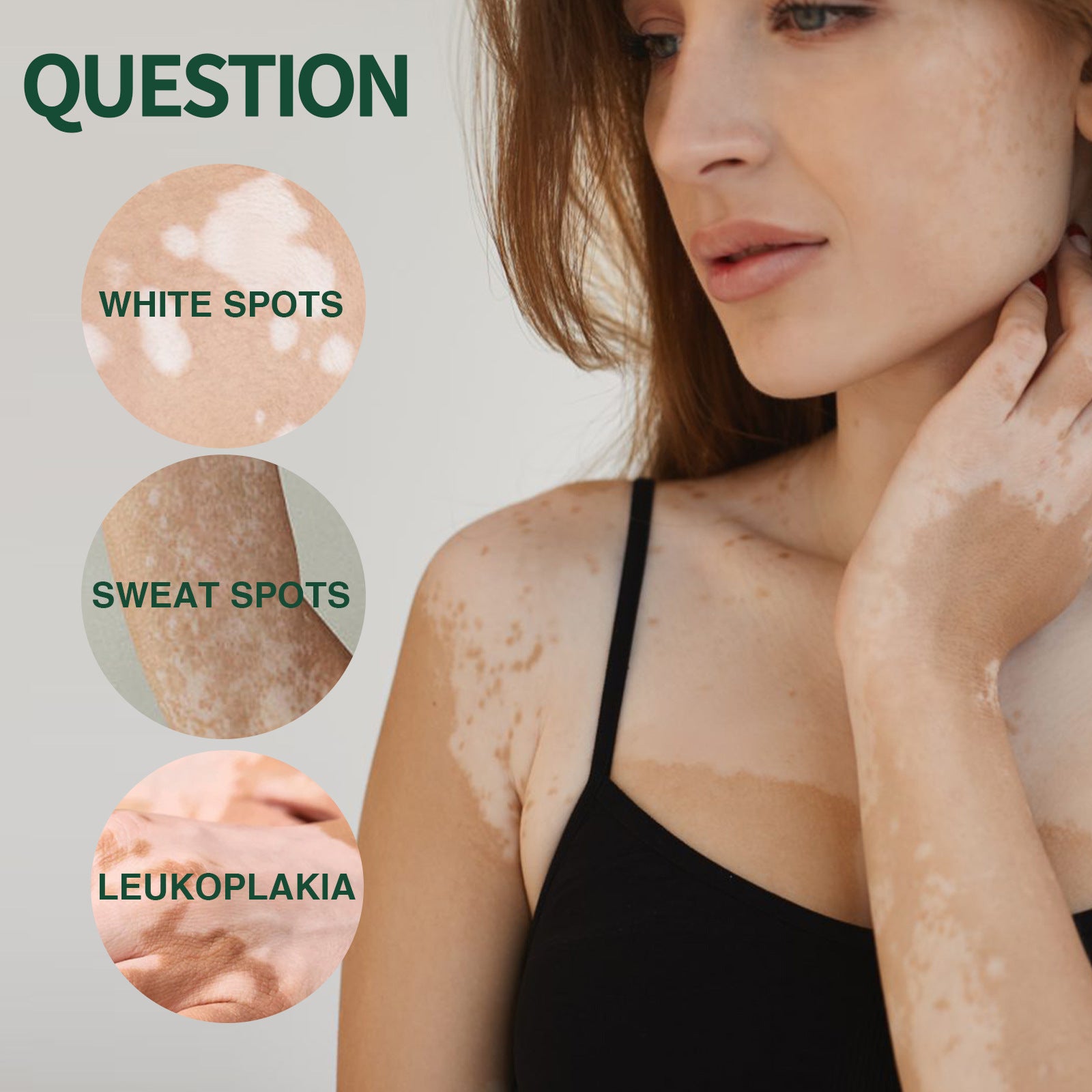 Crème pour le cou Réparatrice contre les taches blanches, la décoloration et la mousse de peau sur les mains et les pieds, qui agit efficacement sur la mélanine.