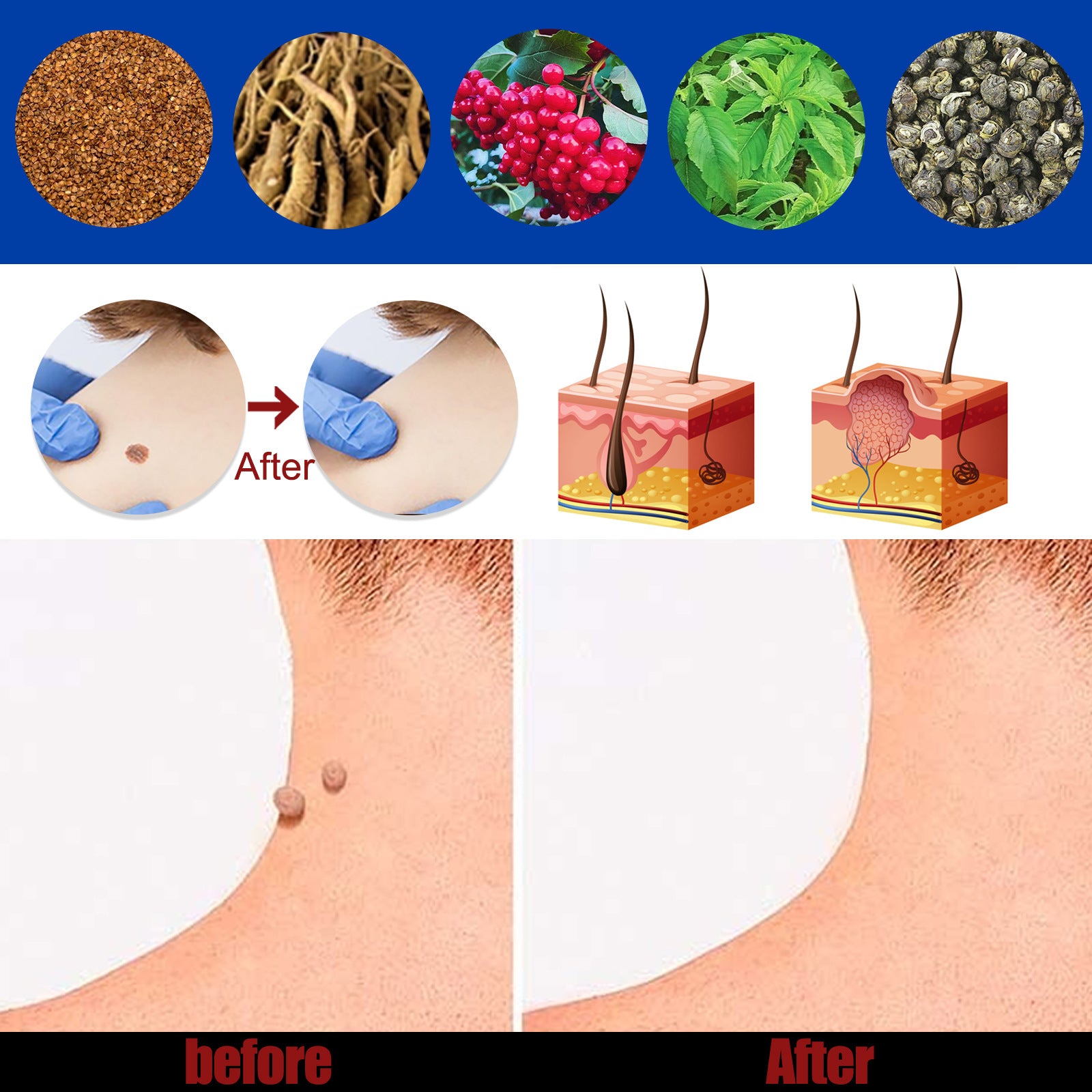 Hand Foot Face Underarm Wart Removing Cream