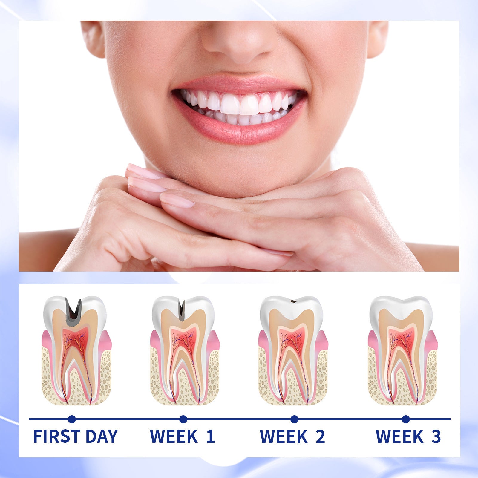 Dentifrice Anticaries Nettoyage Buccal Jaunissement Dentaire Carie Soin Dentaire Fixation Gencives Soin Dentaire Haleine