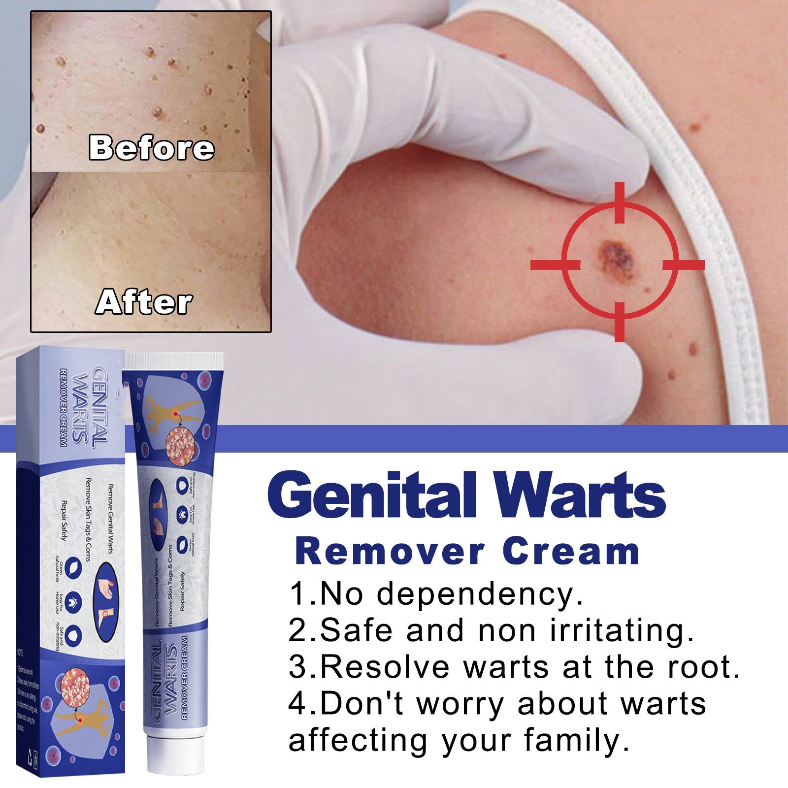 Ping Hou You Qu Wart Cream Hand Foot Facial Underarm Meat Granules