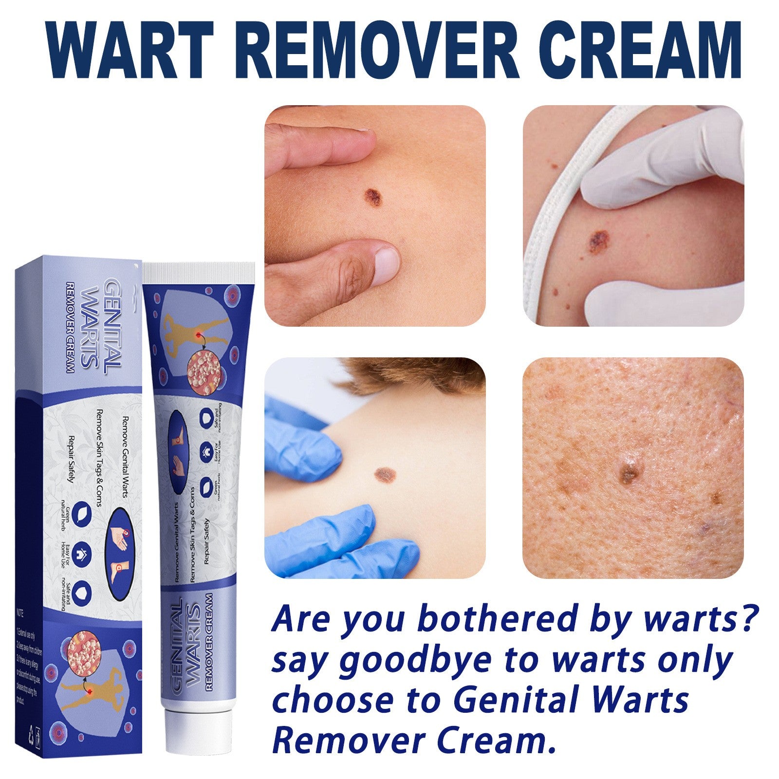 Ping Hou You Qu Wart Cream Hand Foot Facial Underarm Meat Granules