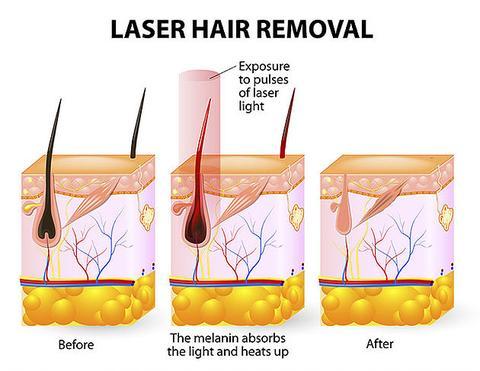 Appareil d'épilation au laser