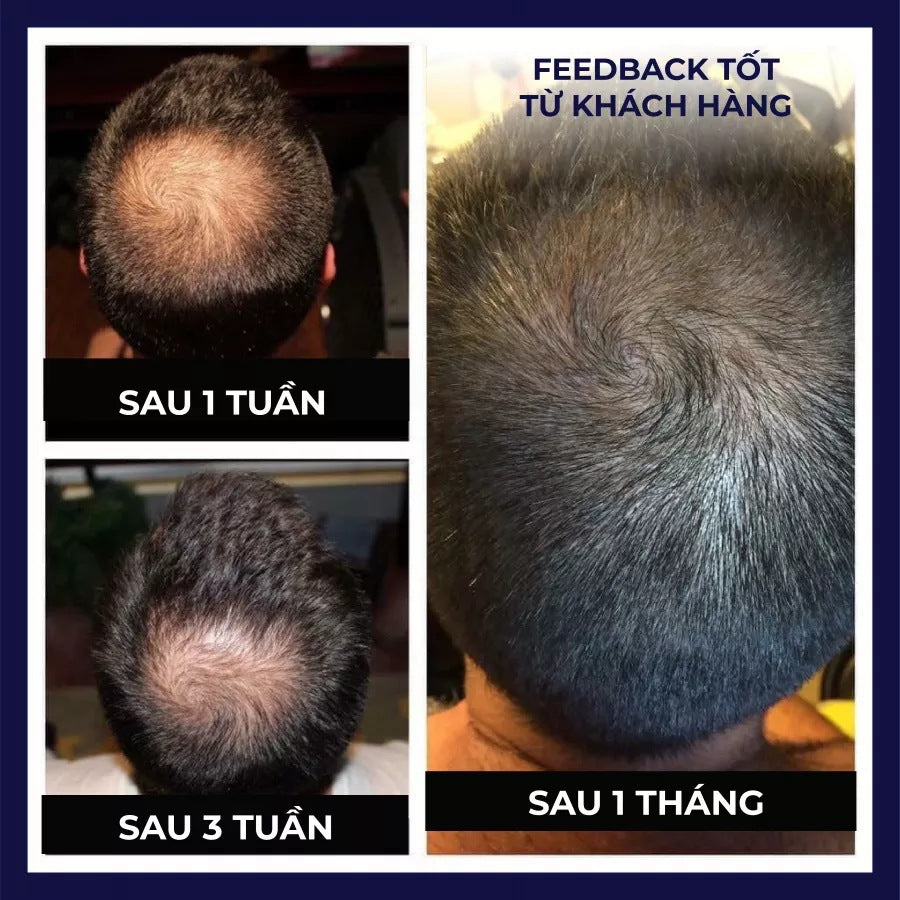 EFG Hair Growth Spray Regrowth