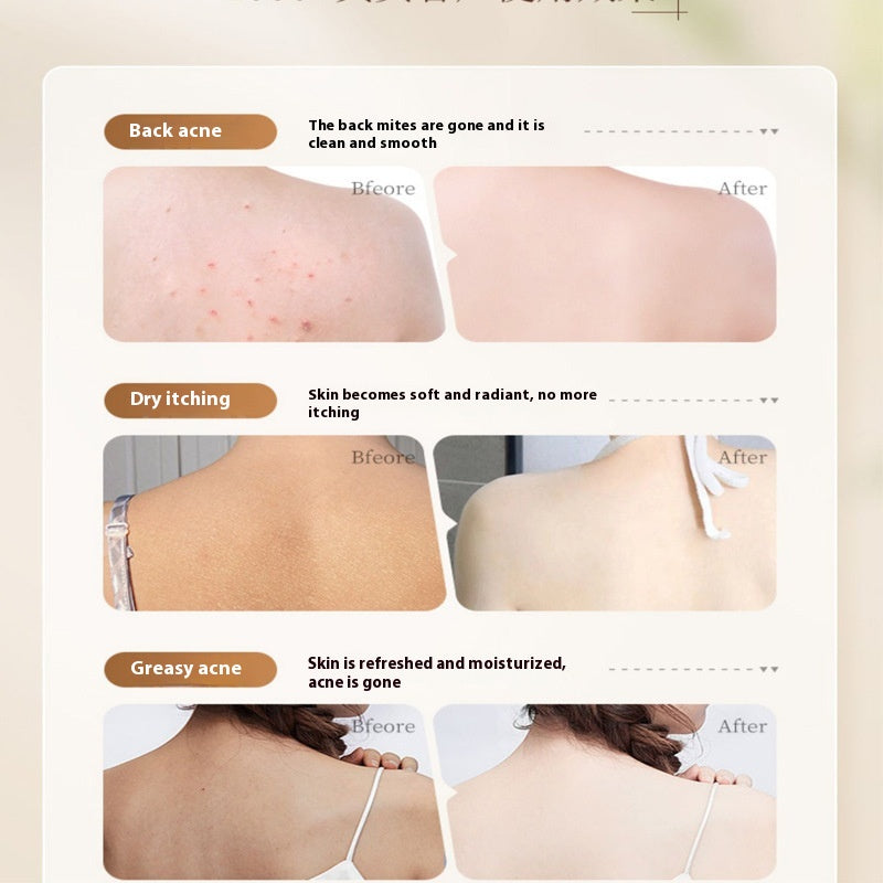 Shower Gel Back Acne Removing Mite-removal Chicken Skin Men And Women Lasting Fragrance Lotion
