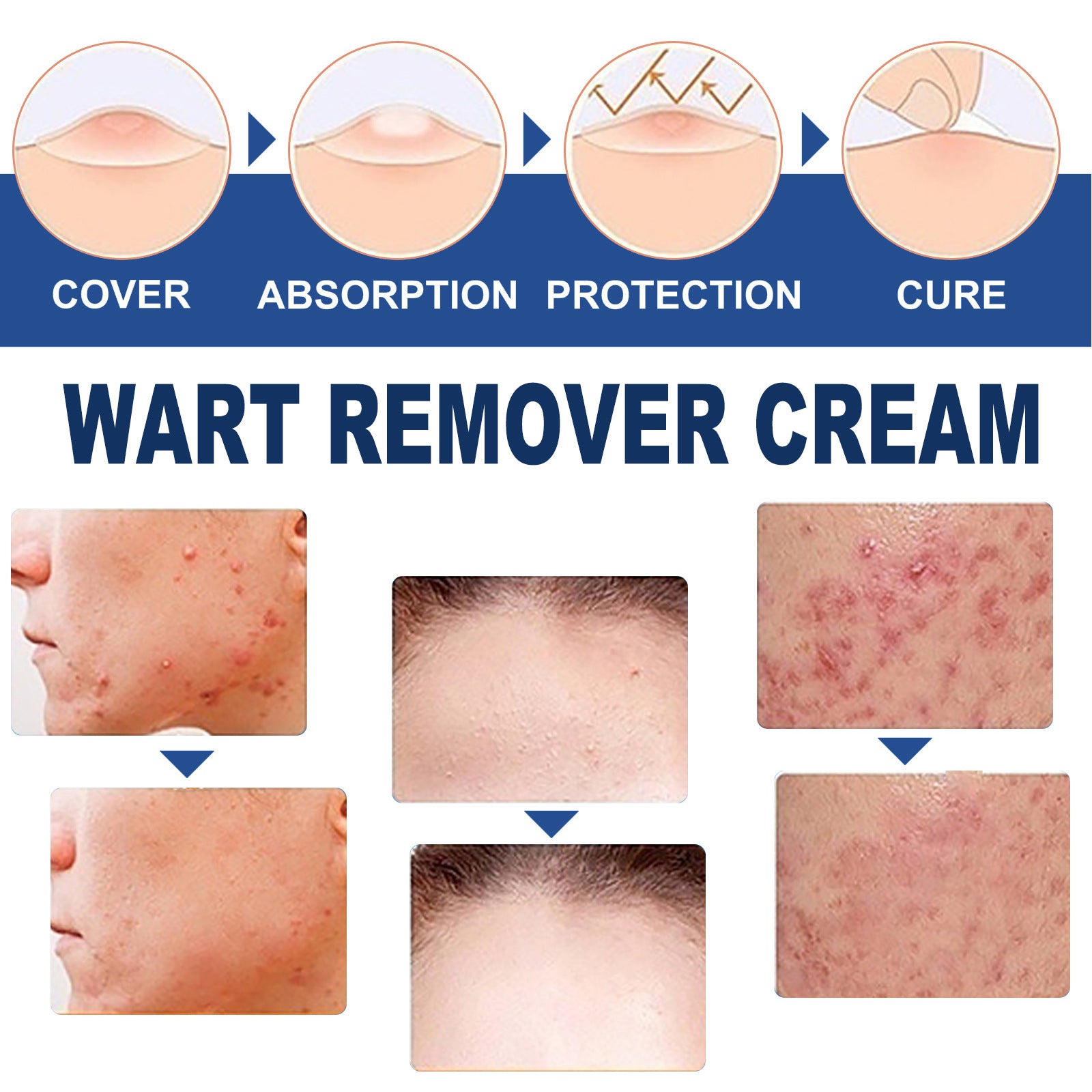 Ping Hou You Qu Wart Cream Hand Foot Facial Underarm Meat Granules