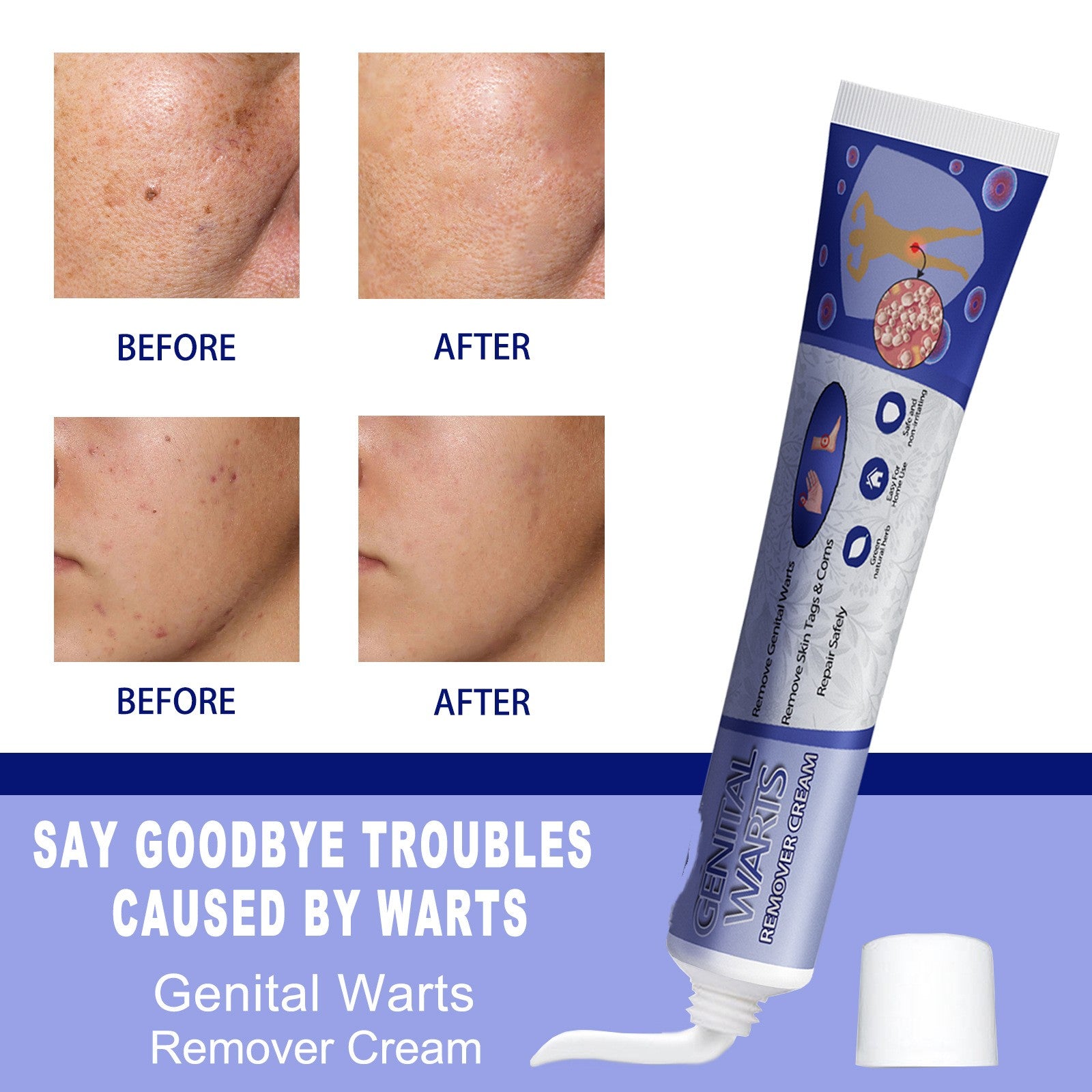Ping Hou You Qu Wart Cream Hand Foot Facial Underarm Meat Granules